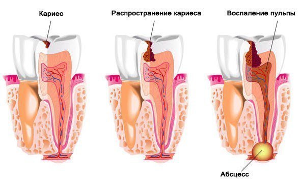 Как остановить кариес в домашних условиях Как остановить кариес в домашних условиях