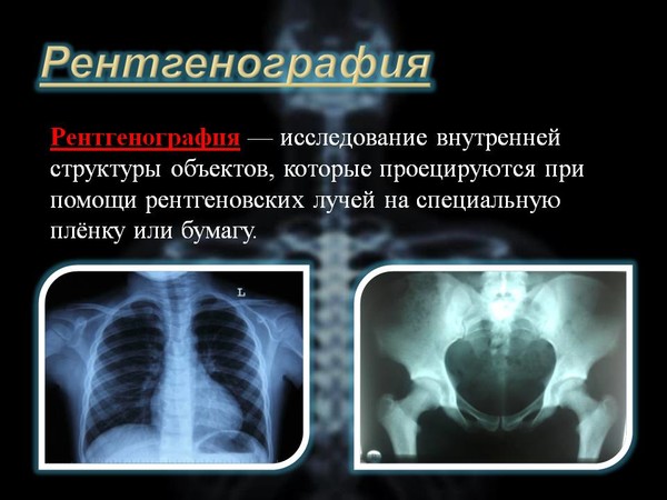 Рентген на дому Москва, Флюорография на дом Москва, Цифровой рентген на дому Москва, Травматолог на дом Москва, ЛОР на дом Москва , Стоматолог на дом, Нарколог на дом Москва, Психолог на дом, Невролог на дом, УЗИ на дому Москва, ЭКГ на дому Москва, Анализы на дому Москва, бесплатно по полису ДМС добровольное медицинское страхование. 
Балканская рамка - ( аренда и продажа) ; 
#рентгеннадому #рентгеннадомуМосква 
Рентген на дому Москва, Подмосковье, Московская область, Вороново, Красная Пахра, Дмитров, Сергеев Пасад, Орехово Зуево, Новые Ватутинки, Мытищи, Одинцово, Люберцы, Подольск, Троицк, Московский, Красногорск, Лобня, Видное, Новая Москва, Домодедово , Внуково, Красногорск , Дедовск, Истра, Клин, Чехов, Серпухов, 
#рентген_на_дому_шейки_бедра #флюорография_на_дом
Вечером приготовьте себе настой из шиповника (3 столовых ложки на пол-литра кипятка), оставьте его в термосе на всю ночь. С утра в настойку шиповника (по объёму половина термоса) добавьте три столовых ложки сорбита, размешайте и выпейте всё сразу. Оставшуюся часть шиповника выпейте спустя 20 минут.По истечении часа можете приступать к завтраку. Лучше, если это будут фрукты или овощи, орехи, настойки. Как вариант - сухари. 
Рекомендуем активно двигаться, но не спешите после чистки сорбитом выходить на улицу - советуем выходить только тогда, когда опорожните кишечник; из вашего организма выйдут накопленные шлаки. Рекомендуется после чистки печени сделать очистительную клизму 
Процедуру рекомендуется повторять 6 раз через каждые пару дней, поскольку может выйти не вся "грязь". 
Затем можно реже проводить такую чистку - примерно раз в неделю 
.Шиповник и сорбит поможет очистить лимфатические узлы печени, а это очень положительно влияет на состояние вашего организма в целом. 
Очищение печени сорбитом и шиповникам, как и любые другие методы чистки дома - достаточно непростая вещь. Нужно выделить на это несколько дней, и посвятить их только себе и своему здоровью. Чистку печени рекомендуется проводить только после полной очистки кишечника. 
Консультация врача необходима в любом случае. 
Перед применением рецептов требуется консультация специалиста
#рентген_в_москве, #рентген_легких, #перелом_шейки_бедра, #шейка_бедра, #сделать_рентген, #сделать_рентген_на_дому, #вызвать_врача, #вызвать_врача_на_дом, #врач_на_дом, #вызвать_травматолога, #травматолог_на_дом, #перелом_ребер, #вправить_вывих, #травматолог, #перелом, #травма #вывих, #флюорография, #флюорография_на_дому, #ушиб, #пневмония #функциональная_кровать #рама_балканского 
#рентгеннадому #рентгеннадомуМосква 
#Рама_Балканского 
#травматолог_на_дом_Москва 
#рентген_на_дому_шейки_бедра_Москва 
#рентген_на_дому_лёгкие_Москва 
#рентген_на_дому_позвоночника_Москва 
#рентген_на_дому_отзывы_Москва 
#сделать_рентген_на_дому_Москва 
#вызвать_рентген_на_дом_Москва 
#рентген_на_дому_тазобедренного_сустав 
#Московский_рентген_Рентген_на_дому_шейки_бедра